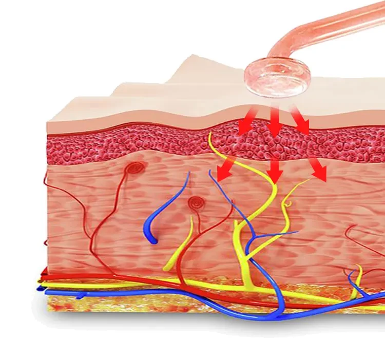 Use DARSONVAL apparatus for acne removal